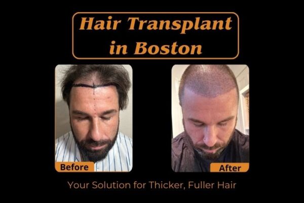 Hair-Transplant-in-Boston-Your-Solution-for-Thicker-Fuller-Hair