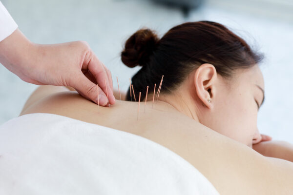 Acupuncture for Stress and Anxiety Management