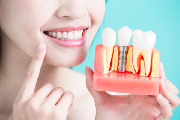 Top 5 Questions New Patients Ask About Dental Implants in Miami