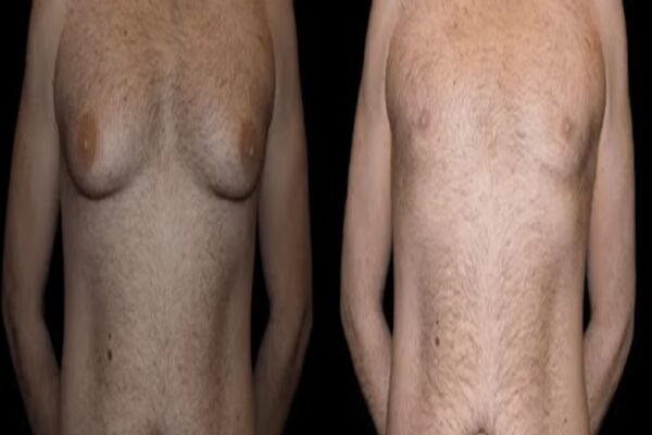 Before and After Male Breast Reduction Result