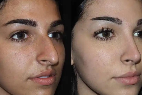 Top Tips for Selecting the Best Rhinoplasty Surgeon in Dubai