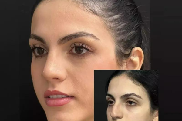 Finding the Best Septoplasty Surgeon in Dubai: Your Guide to Expert Care and Lasting Results