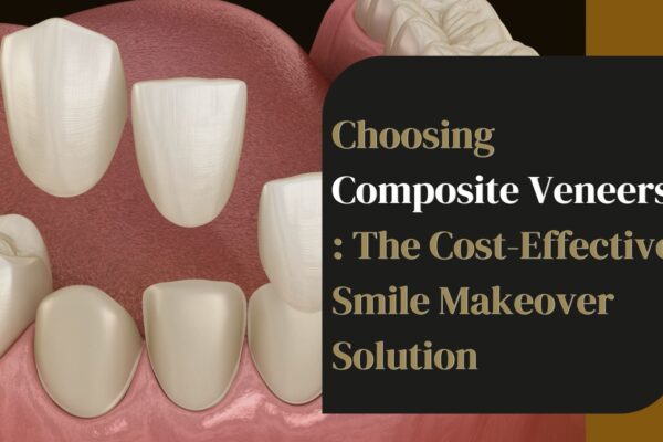 Composite Veneers