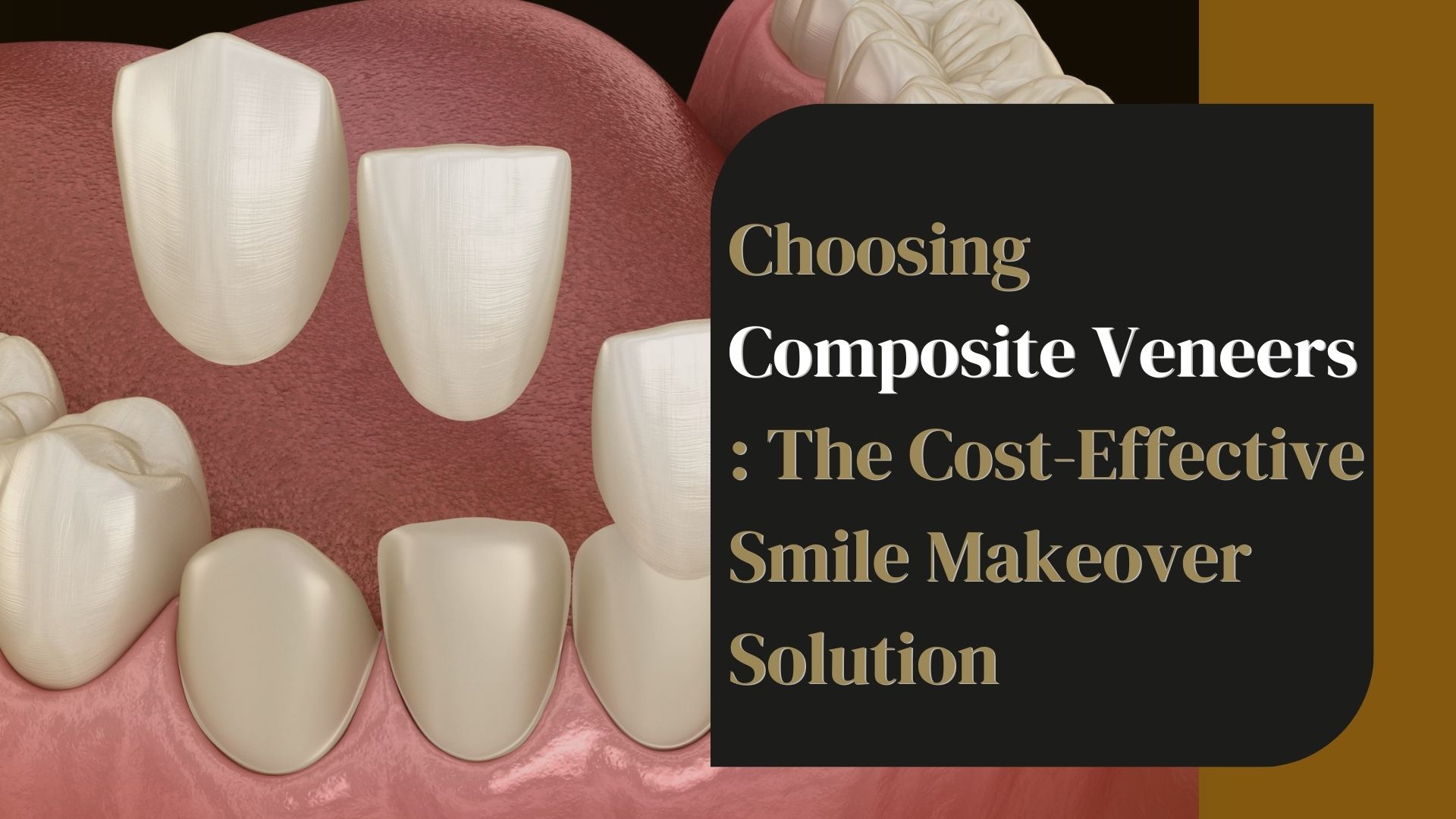 Composite Veneers