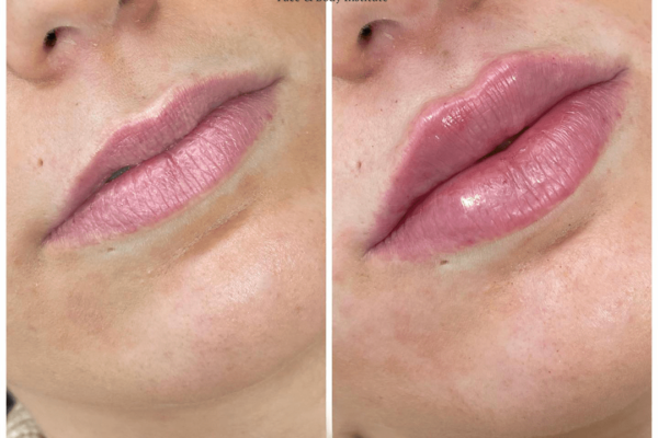 Juvederm fillers