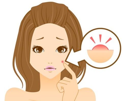 How To Manage Your Acne And Stay Acne Free