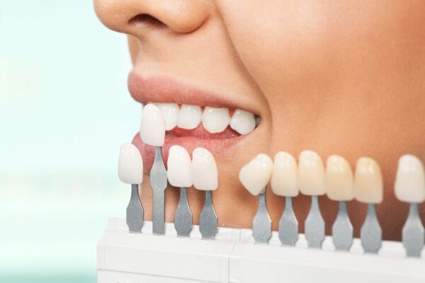 dental veneers Hayward Wisconsin