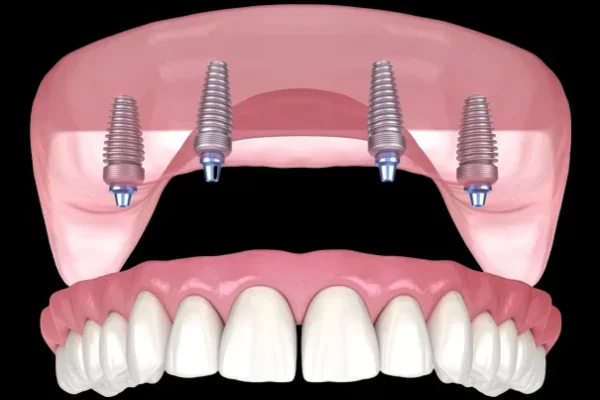 All-on-4 Implants Aberdeen