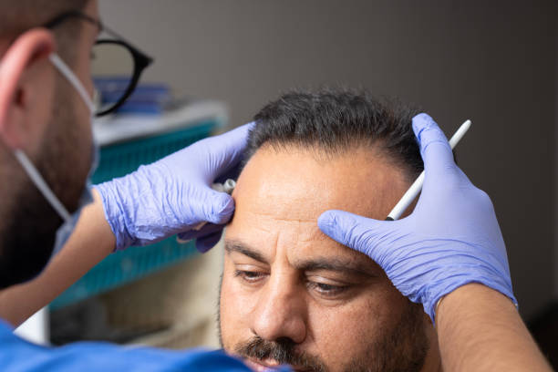 Hair Transplant in Riyadh