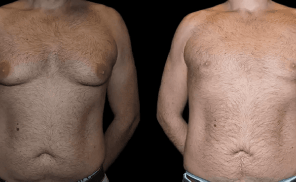 male breast reduction with before and after photos