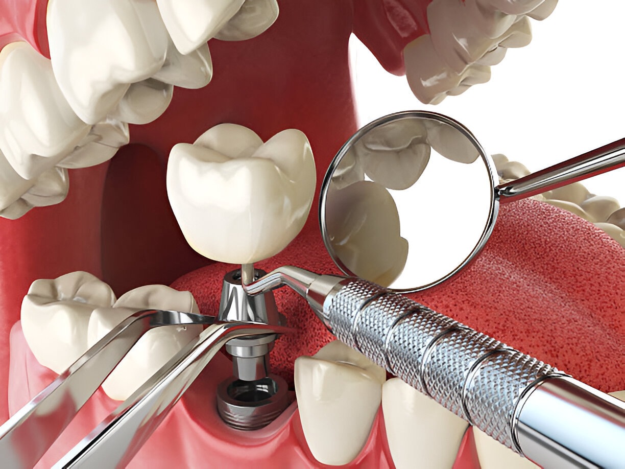 Dental Implants in Keller