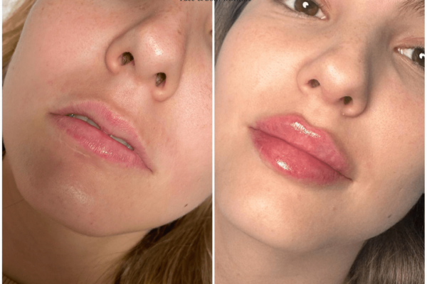 Juvederm