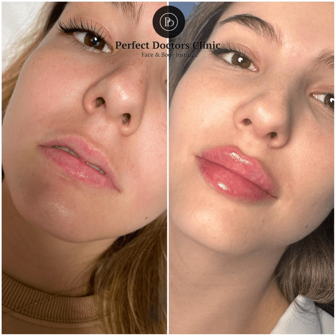 Juvederm