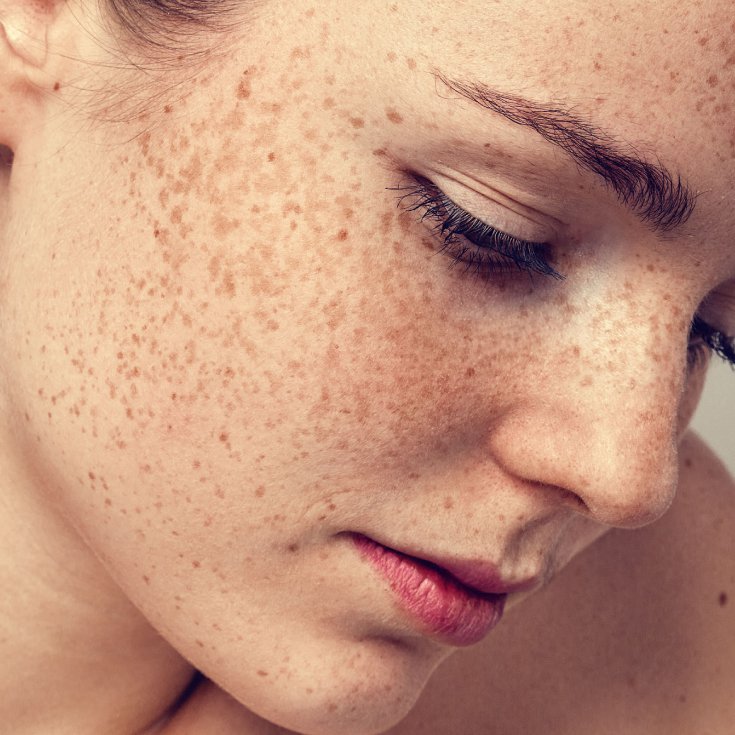 Hyperpigmentation Treatment Chigwell