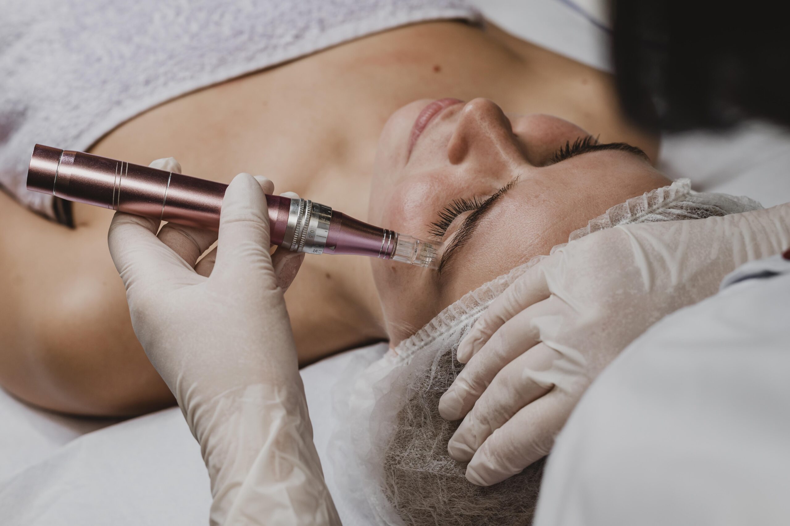 micro-needling north york