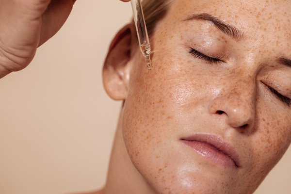 Melasma Treatment Loughton