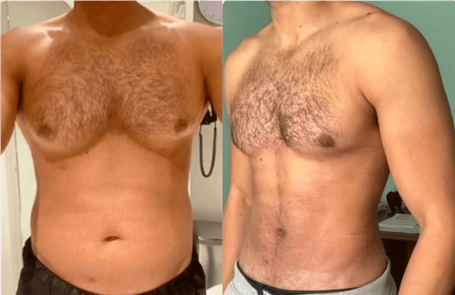 Best Gynecomastia Surgeons in Dubai