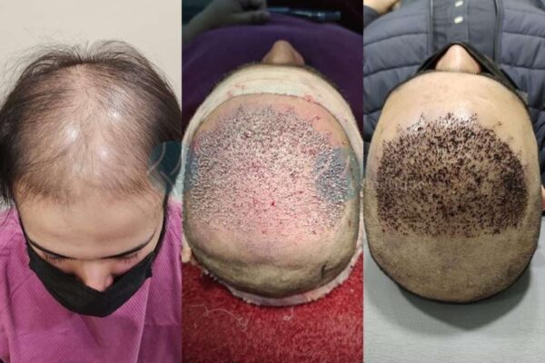 Hair Transplant in Pakistan