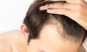 How to Choose the Best Hair Transplant Clinic in London