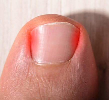 ingrown toenail removal San Antonio